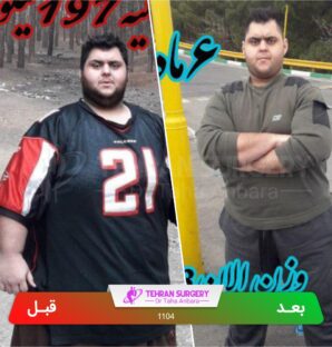 عکس قبل و بعد جراحی لاغری