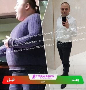 عکس قبل و بعد جراحی لاغری