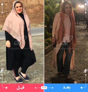 عکس قبل و بعد جراحی لاغری