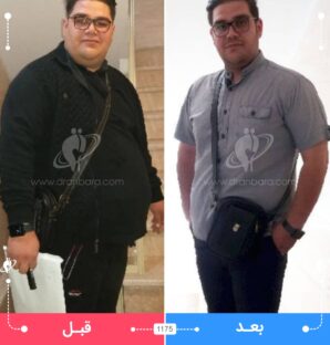 عکس قبل و بعد جراحی لاغری