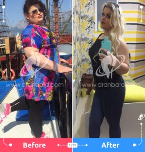 عکس قبل و بعد جراحی لاغری