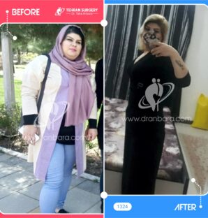 عکس قبل و بعد جراحی لاغری