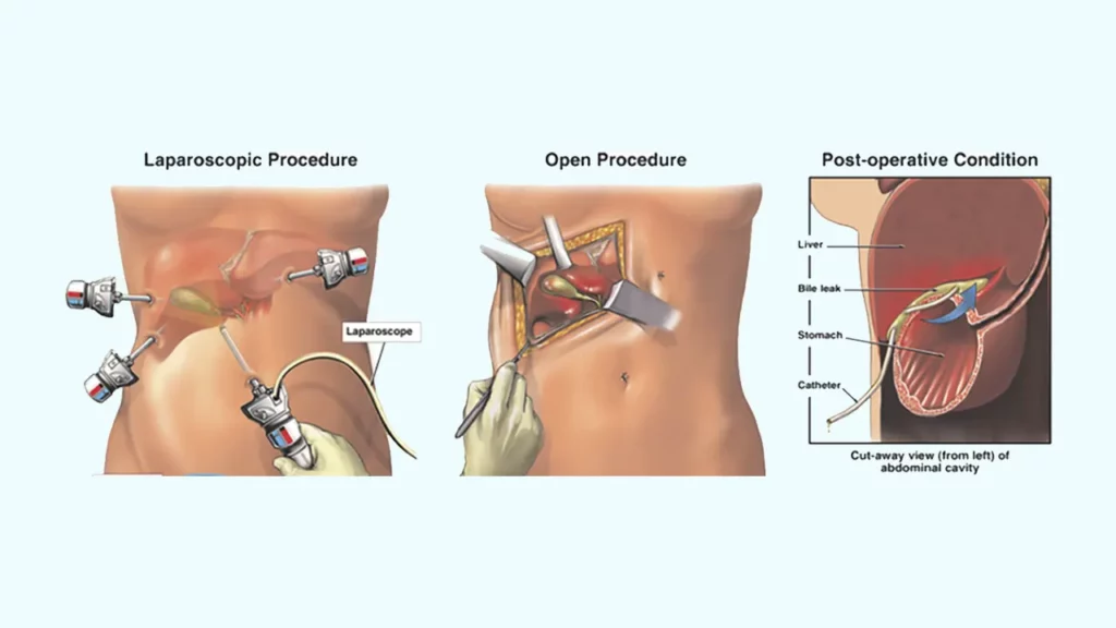 Differences between open and laparoscopic surgery for gallbladder stone removal