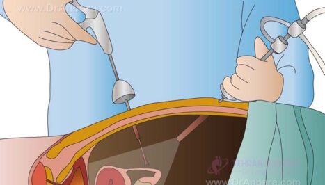 laparoscopic surgery