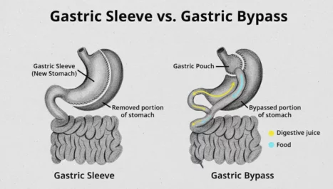 Gastric Sleeve vs. Gastric Bypass