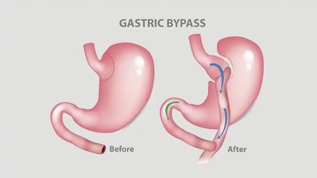 Schematic image before and after gastric bypass surgery