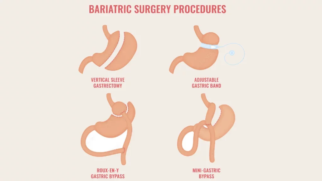 Schematic photo of various types of modern bariatric surgeries