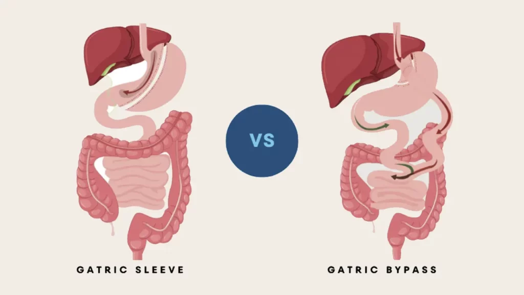 Gastric Sleeve vs. Gastric Bypass