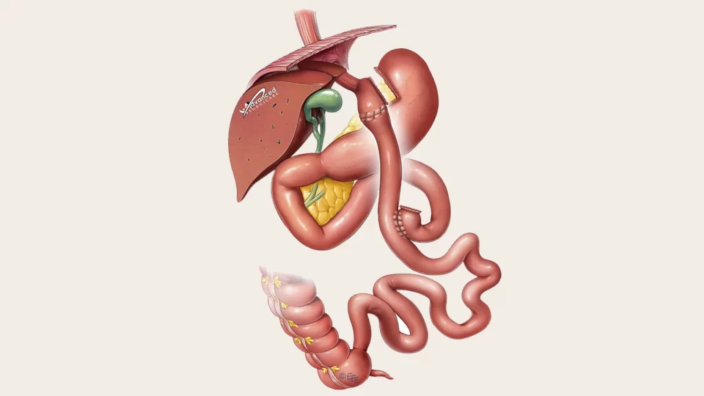 Schematic photo of gastric bypass surgery to treat type 2 diabetes