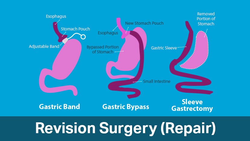 Revision bariatric surgery