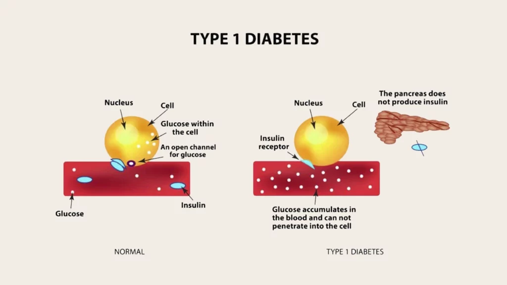 Picture of normal blood sugar versus type 1 diabetes