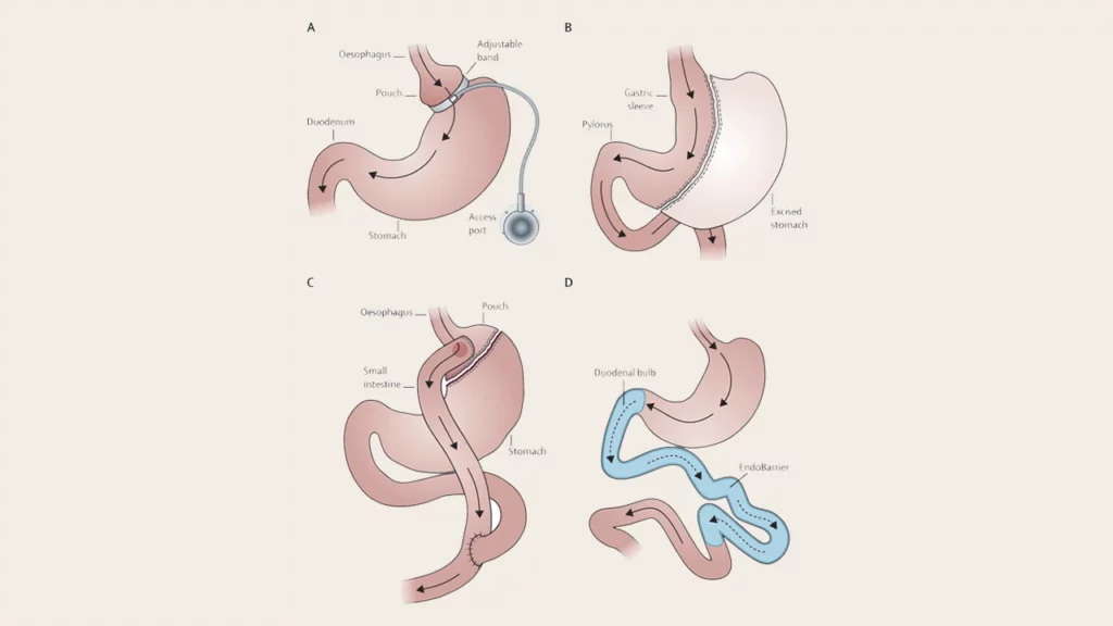 Schematic image of types of bariatric surgery