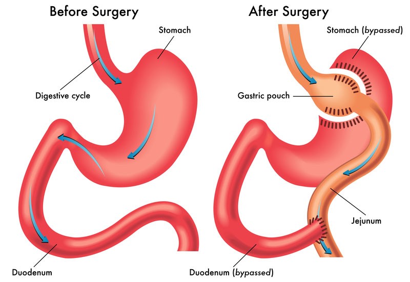 gastric bypass surgery