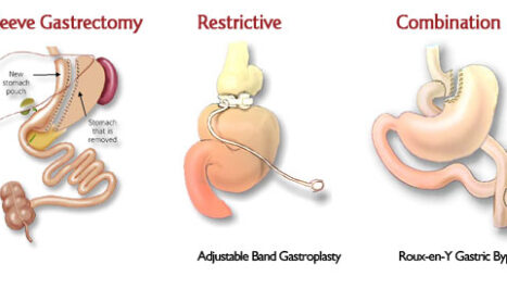 weight loss surgery