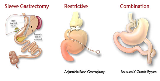 weight loss surgery