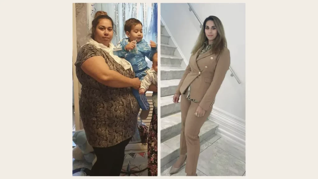 Before and after photo of a woman after gastric bypass surgery