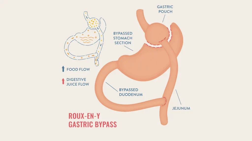 Gastric bypass mechanism of action in a frame