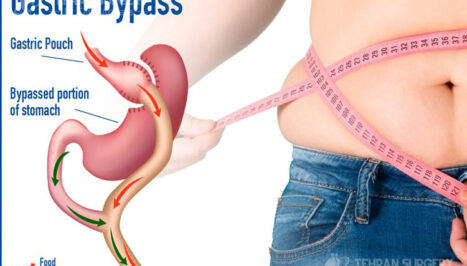 Gastric bypass risks and complications