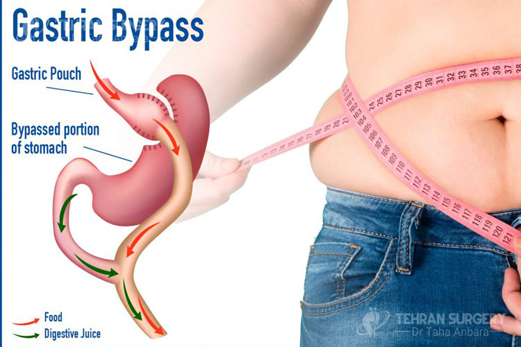 Gastric bypass risks and complications