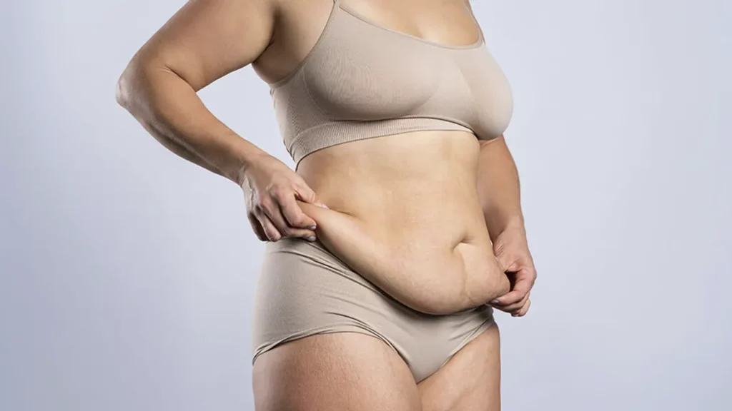 A woman who developed sagging skin after gastric sleeve surgery due to rapid weight loss