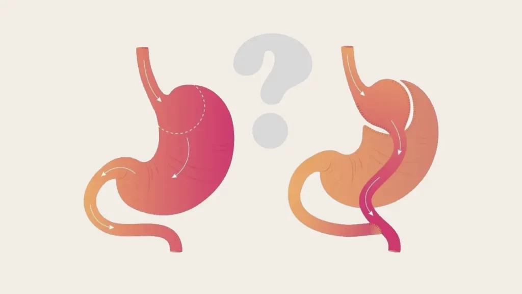 Common questions and answers about gastric bypass surgery