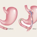 Schematic image before and after gastric bypass surgery
