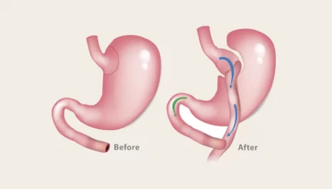 Schematic image before and after gastric bypass surgery