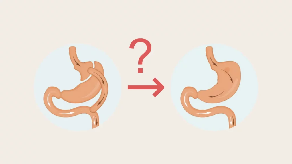 Schematic image showing whether mini-bypass surgery is reversible or not