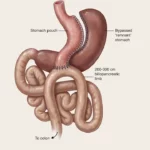 Schematic photo of mini gastric bypass surgery