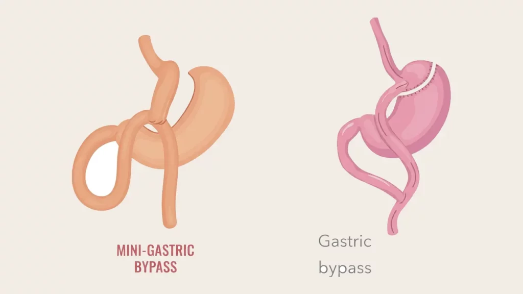 Photo comparison of mini bypass and bypass surgery