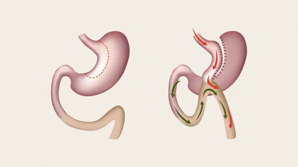 Photo of the stomach before and after mini gastric bypass surgery