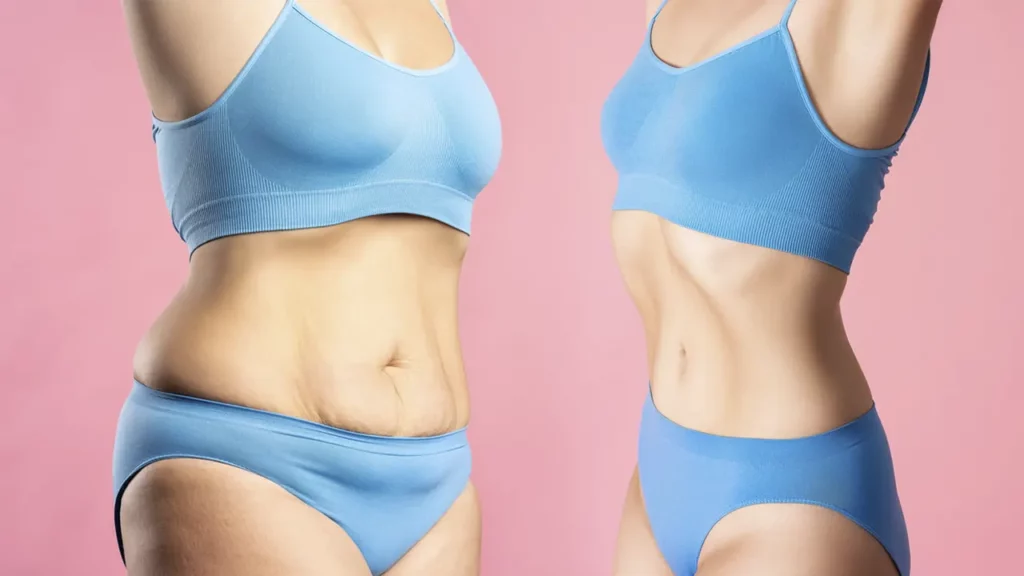 Before and after weight loss surgery on a young woman