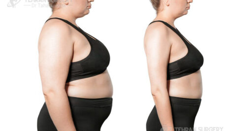 Weight loss surgery stories