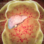 Obesity and fatty liver disease