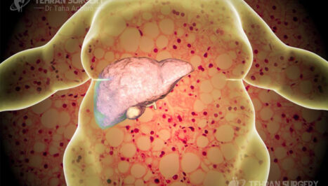 Obesity and fatty liver disease