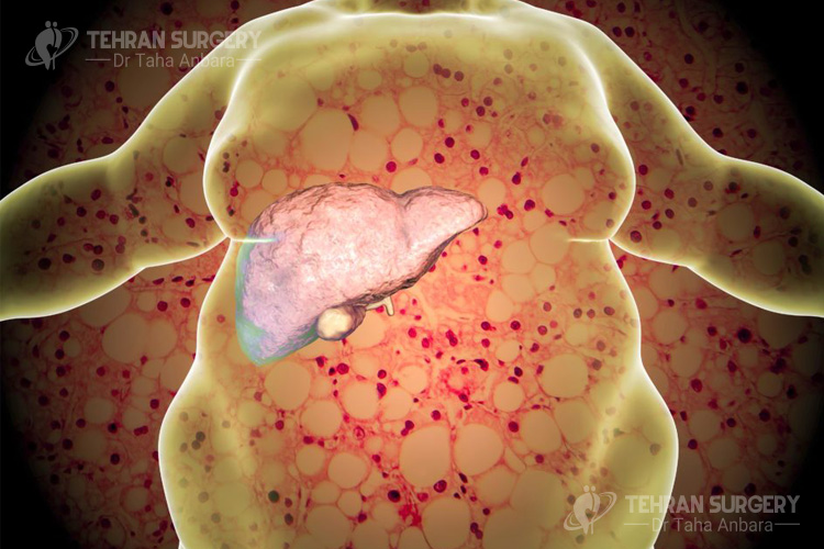 Obesity and fatty liver disease