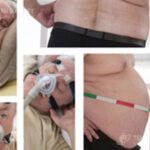 Obesity and sleep apnea