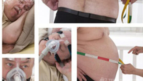 Obesity and sleep apnea