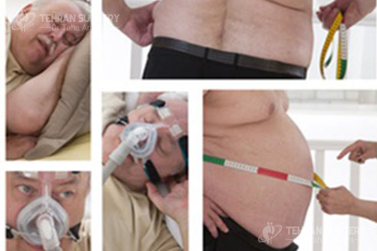 Obesity and sleep apnea