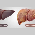 Photo comparing healthy liver with fatty liver