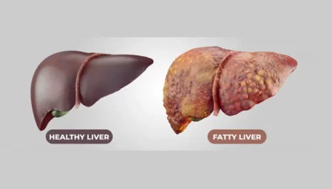 Photo comparing healthy liver with fatty liver