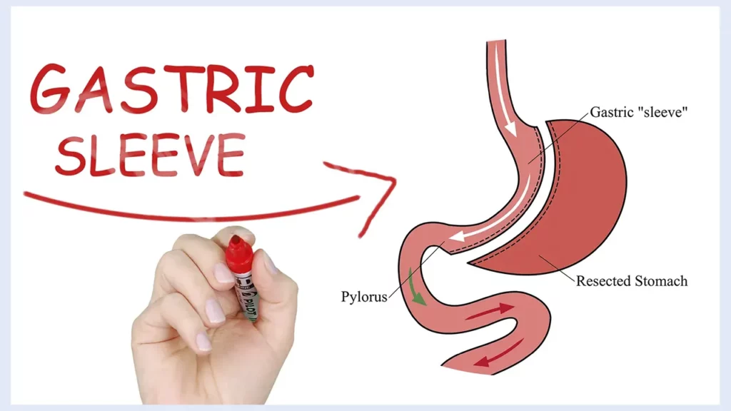 Schematic photo of gastric sleeve surgery