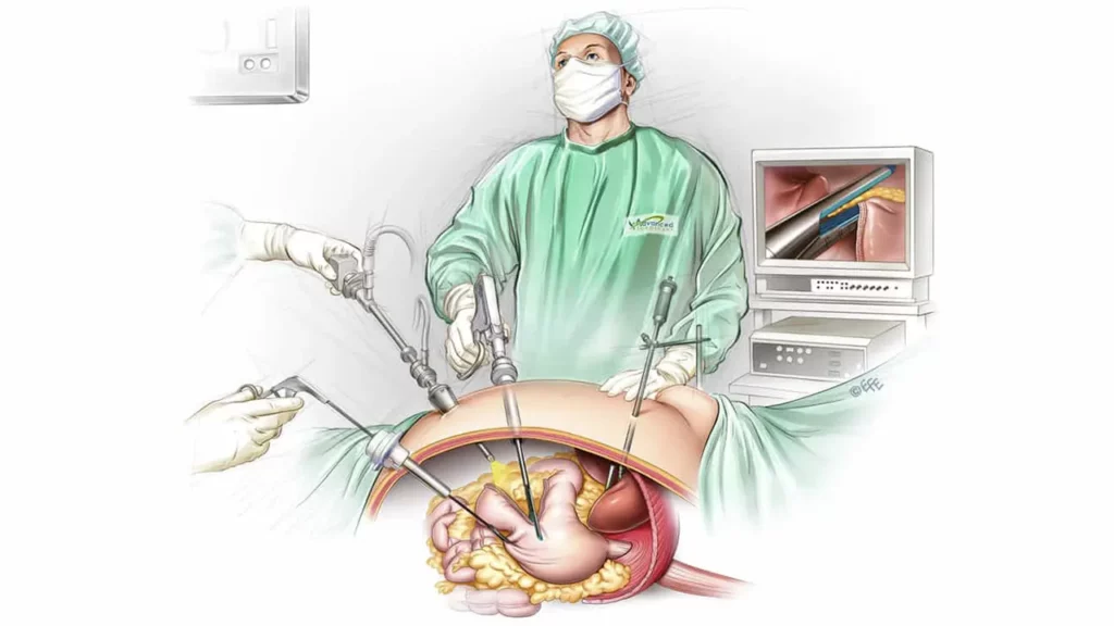 Schematic illustration of a surgeon performing gastric sleeve surgery.