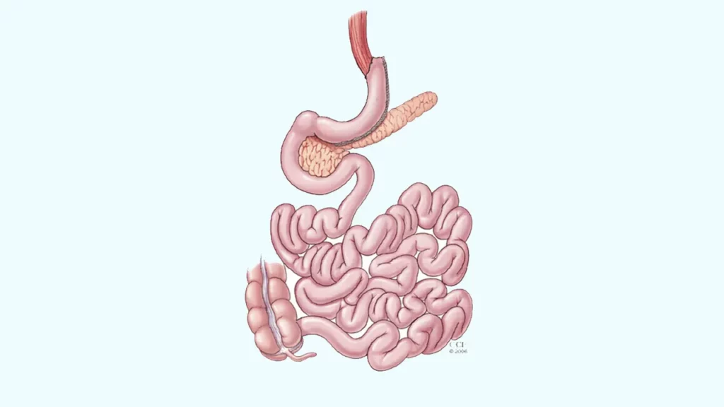 The shape of the stomach after gastric sleeve surgery