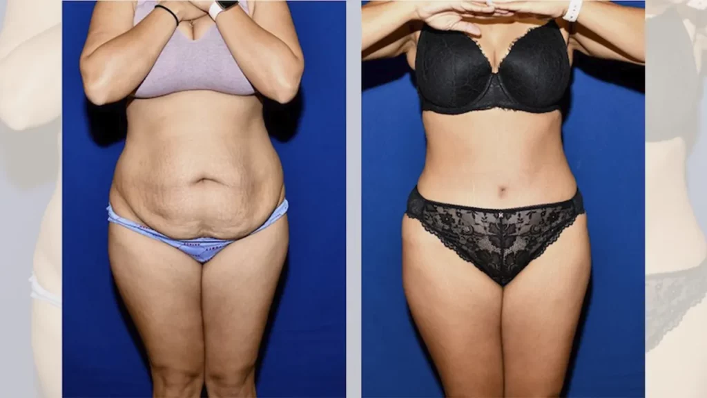 Before and after photos of abdominoplasty