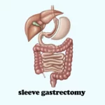 sleeve gastrectomy