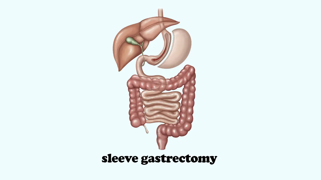 sleeve gastrectomy